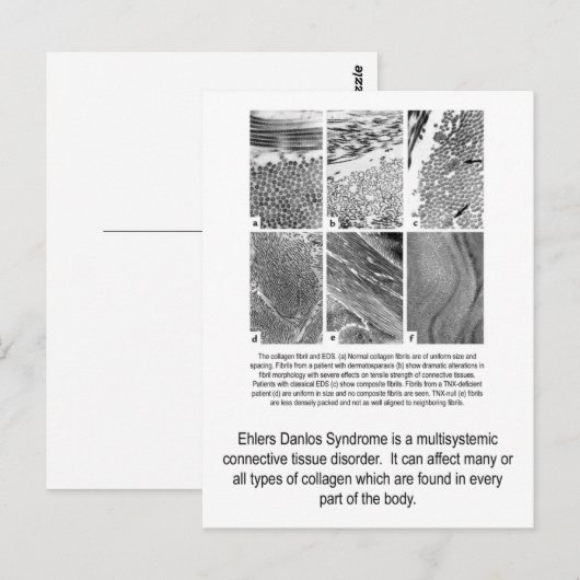 Het defecte EDS van het Collageen Briefkaart van (Voorkant / Achterkant)