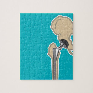 Heupgewrichtsvervanging Legpuzzel