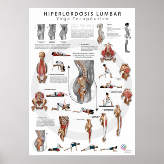 Hiperlordosis - definición, causas y tratamiento poster