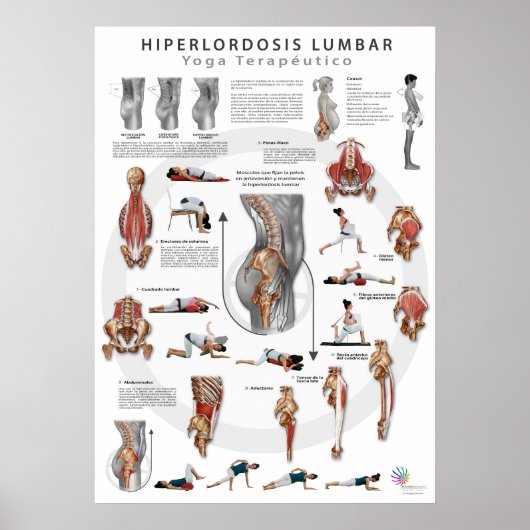 Hiperlordosis - definición, causas y tratamiento poster (Voorkant)