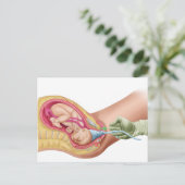 Illustratie met de resultaten van foetus 1 briefkaart (Staand voorkant)