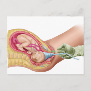 Illustratie met de resultaten van foetus 1 briefkaart