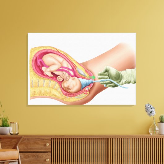 Illustratie met de resultaten van foetus 1 canvas afdruk (Insitu (Woonkamer))