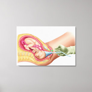 Illustratie met de resultaten van foetus 1 canvas afdruk