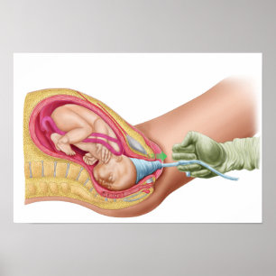 Illustratie met de resultaten van foetus 1 poster