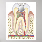 Illustratie van de gebitsvulling poster (Voorkant)