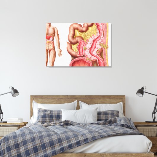 Illustratie van diverticulose in de darm canvas afdruk (Insitu (Slaapkamer))