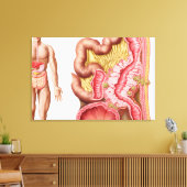 Illustratie van diverticulose in de darm canvas afdruk (Insitu (Woonkamer))