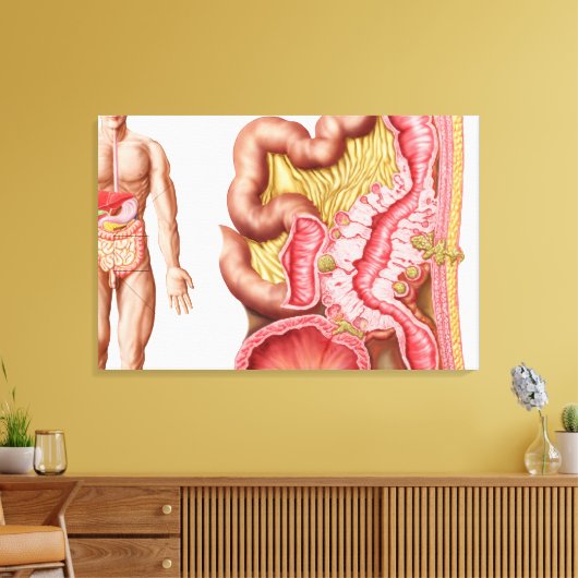 Illustratie van diverticulose in de darm canvas afdruk (Insitu (Woonkamer))