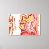 Illustratie van diverticulose in de darm canvas afdruk (Voorkant)