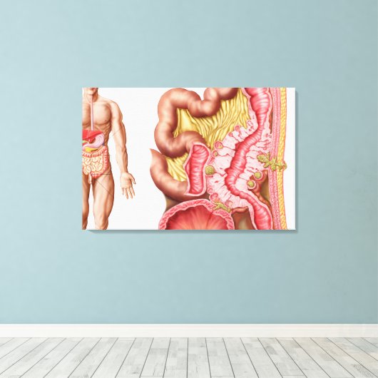 Illustratie van diverticulose in de darm canvas afdruk (Insitu (Houten vloer))
