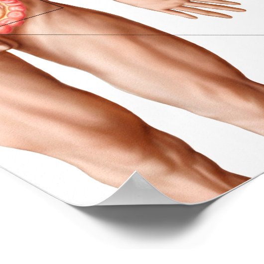 Illustratie van diverticulose in de darm poster (Hoek)