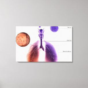 Illustratie van een astmaaanval van stuifmeel canvas afdruk