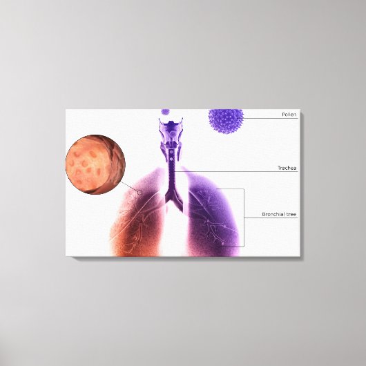 Illustratie van een astmaaanval van stuifmeel canvas afdruk (Voorkant)