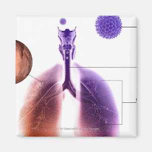 Illustratie van een astmaaanval van stuifmeel magneet