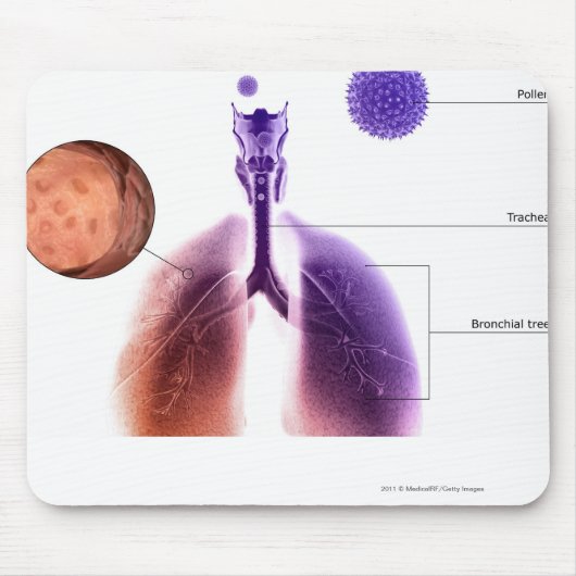Illustratie van een astmaaanval van stuifmeel muismat (Voorkant)