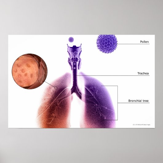 Illustratie van een astmaaanval van stuifmeel poster (Voorkant)