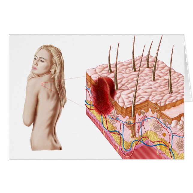 Illustratie van een atypische groei van de huid (Voorkant Horizontaal)