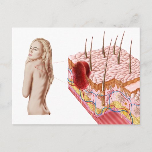 Illustratie van een atypische groei van de huid briefkaart (Voorkant)