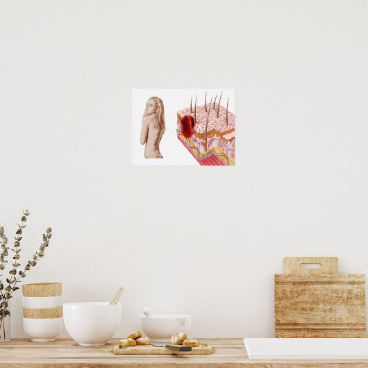 Illustratie van een atypische groei van de huid poster (Keuken)