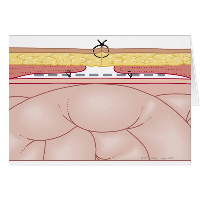 Illustratie van een hernia (Voorkant Horizontaal)