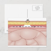 Illustratie van een hernia briefkaart (Voorkant / Achterkant)