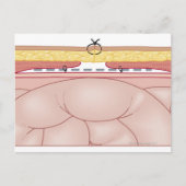 Illustratie van een hernia briefkaart (Voorkant)