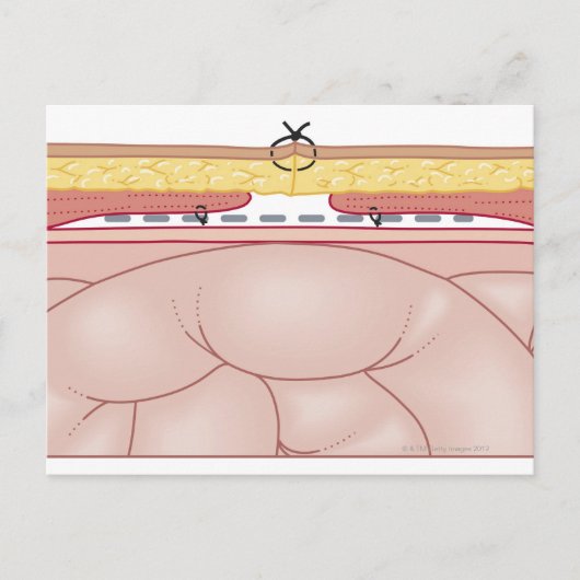 Illustratie van een hernia briefkaart (Voorkant)