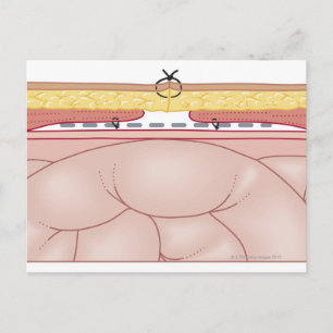 Illustratie van een hernia briefkaart