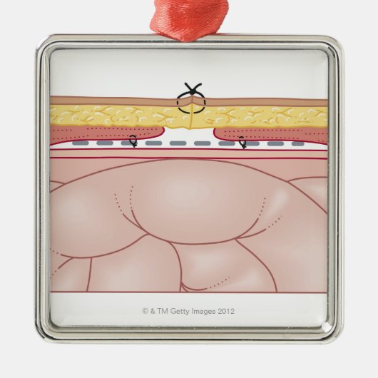Illustratie van een hernia metalen ornament (Voorkant)