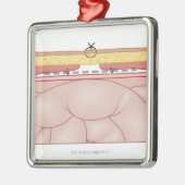 Illustratie van een hernia metalen ornament (Links)