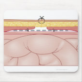 Illustratie van een hernia muismat (Voorkant)