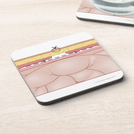 Illustratie van een hernia onderzetter (Linkerzijde)