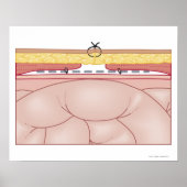 Illustratie van een hernia poster (Voorkant)