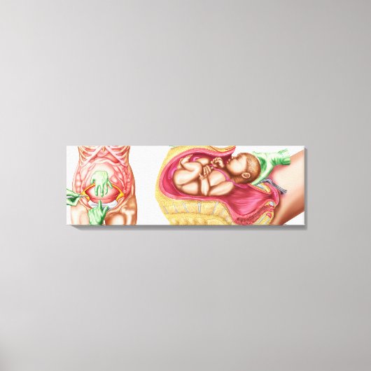 Illustratie waarin keizersnede bij de foetus wordt canvas afdruk (Voorkant)