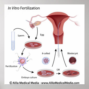 In-vitrofertilisatie (IVF) procedure geëtiketteerd Poster