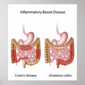 inflammatoire darmziekte ( ibd ) poster (Voorkant)