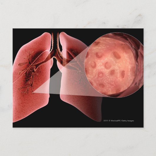 Inflammen van de luchtwegen tijdens een astmaaanva briefkaart (Voorkant)