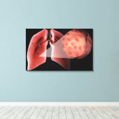 Inflammen van de luchtwegen tijdens een astmaaanva canvas afdruk (Insitu (Houten vloer))