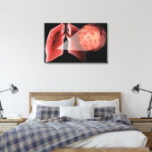 Inflammen van de luchtwegen tijdens een astmaaanva canvas afdruk (Insitu (Slaapkamer))