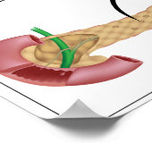 Insulinewerking en diabetes type 1 en 2 Poster (Hoek)