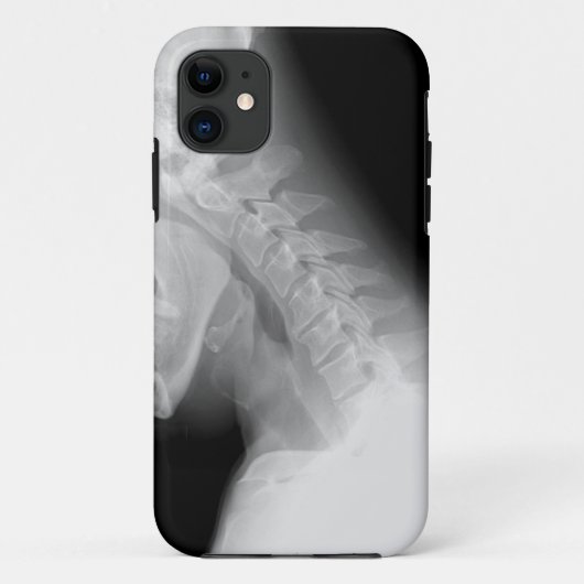 Jaw en Spine X Ray IPhone-draagtas Case-Mate iPhone Case (Achterkant)