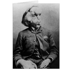 Joseph "John" Merrick The Elephant Man uit 1889
