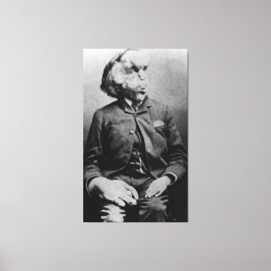 Joseph "John" Merrick The Elephant Man uit 1889 Canvas Afdruk