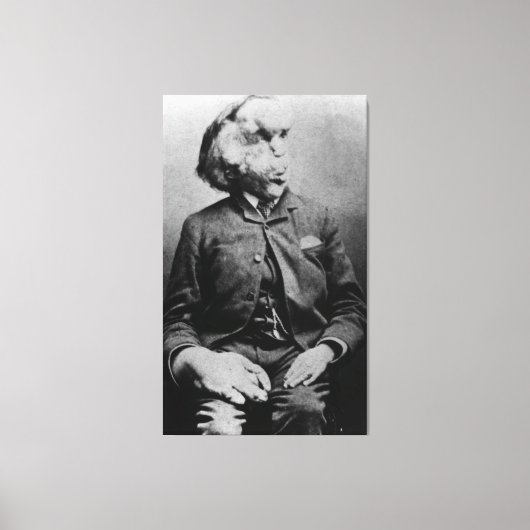 Joseph "John" Merrick The Elephant Man uit 1889 Canvas Afdruk (Voorkant)