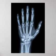 Klinische Röntgenfoto van een hand