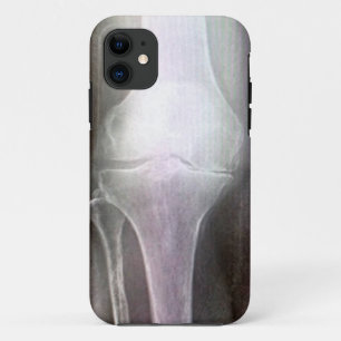 KNEE XRAY IPHONE HOESJE