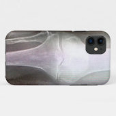 KNEE XRAY IPHONE HOESJE (Achterkant (horizontaal))