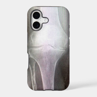 KNEE XRAY IPHONE HOESJE