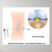 Knie-artroscopiediagram. Poster (Voorkant)